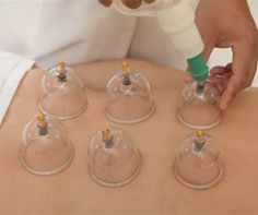 Cupping 1
